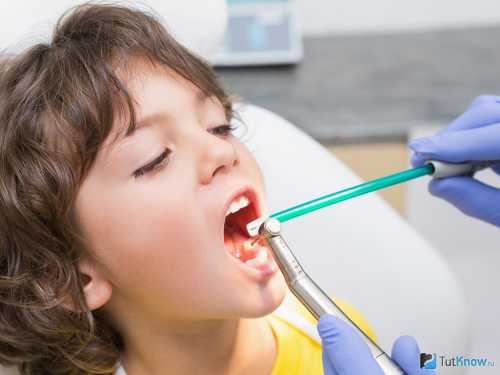 Пульпит молочного зуба может возникнуть даже после незначительного надкола