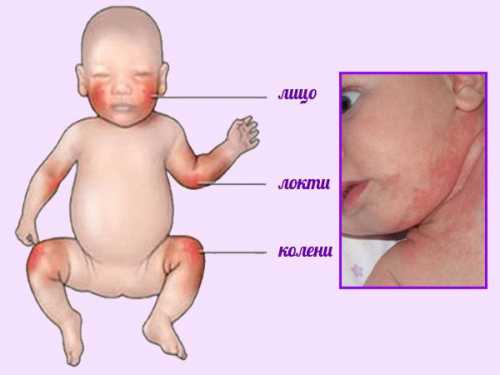 Атопический дерматит у детей: как вылечить