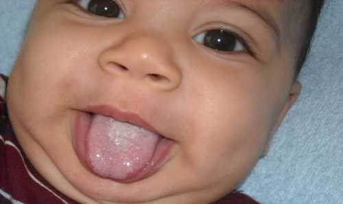 Молочница во рту у новорождённых: как лечить,