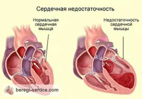 Левожелудочковая сердечнососудистая недостаточность приводит к задержке циркулирующей крови в области малого круга