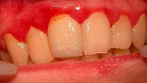 Между зубами и деснами часто образуются глубокие щели, зубы начинают пошатываться, усиливается слюноотделение