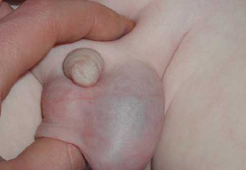 При врождённом нарушении болевых ощущений нет, и водянка яичек не приносит маленькому мальчику беспокойства